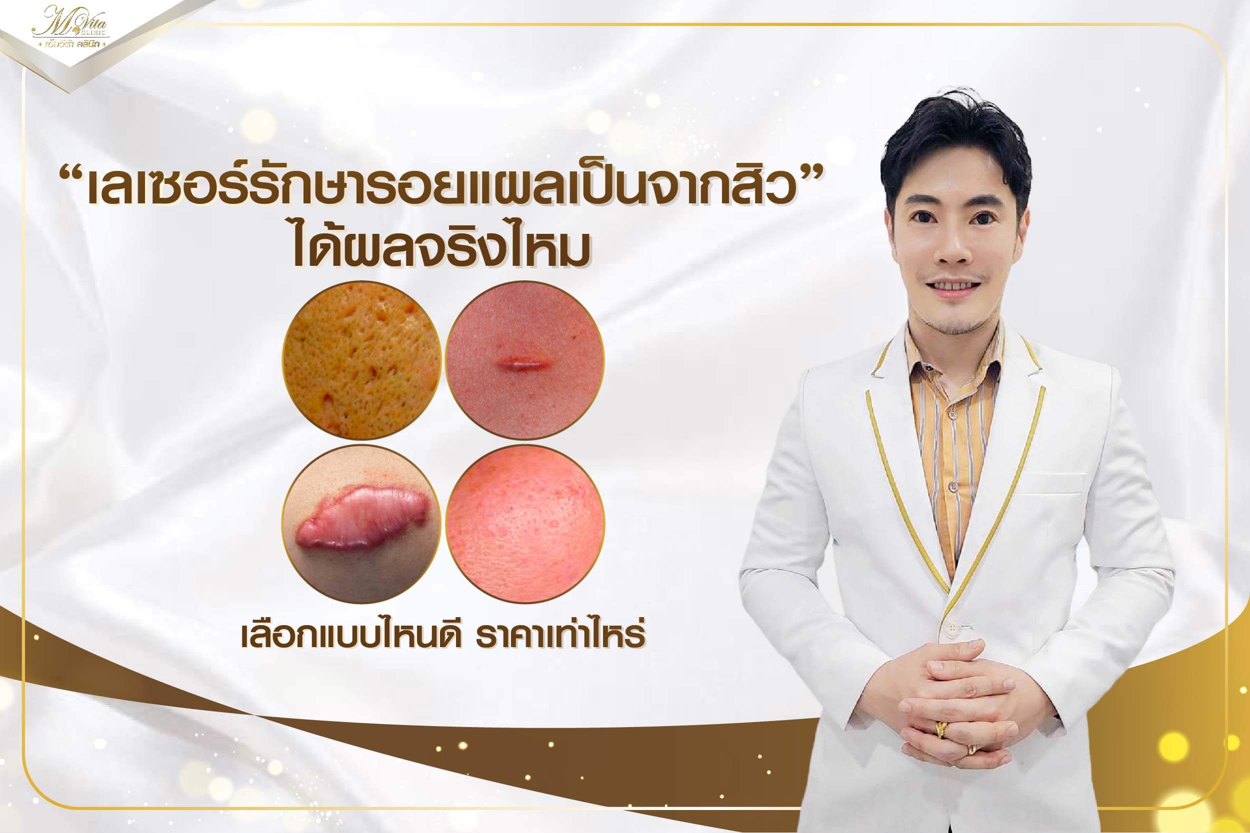 เลเซอร์รักษารอยแผลเป็นจากสิว ได้ผลจริงไหม เลือกแบบไหนดี ราคาเท่าไหร่