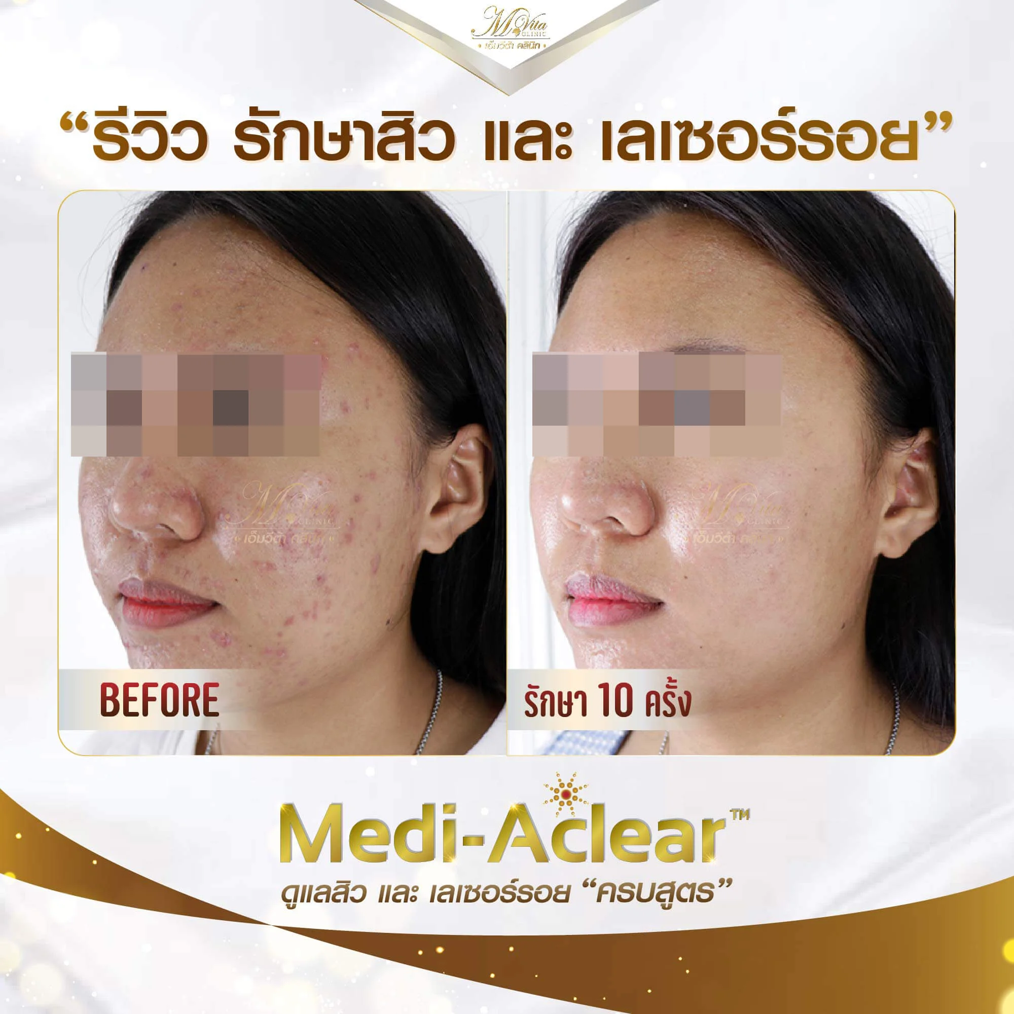 รีวิวรักษาสิวเลเซอร์รอยแดง