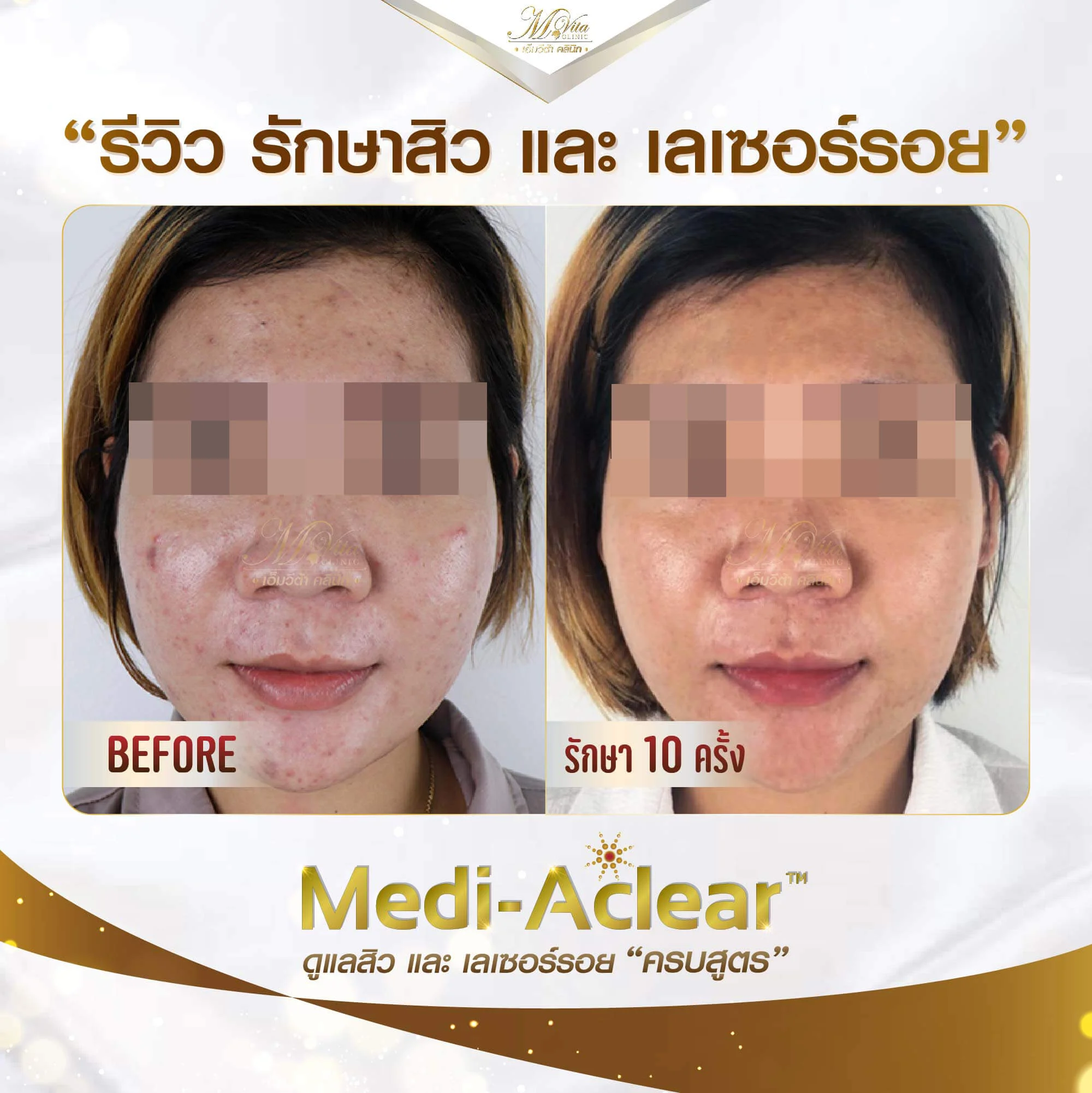 รีวิวรักษาสิวเลเซอร์รอยสิว