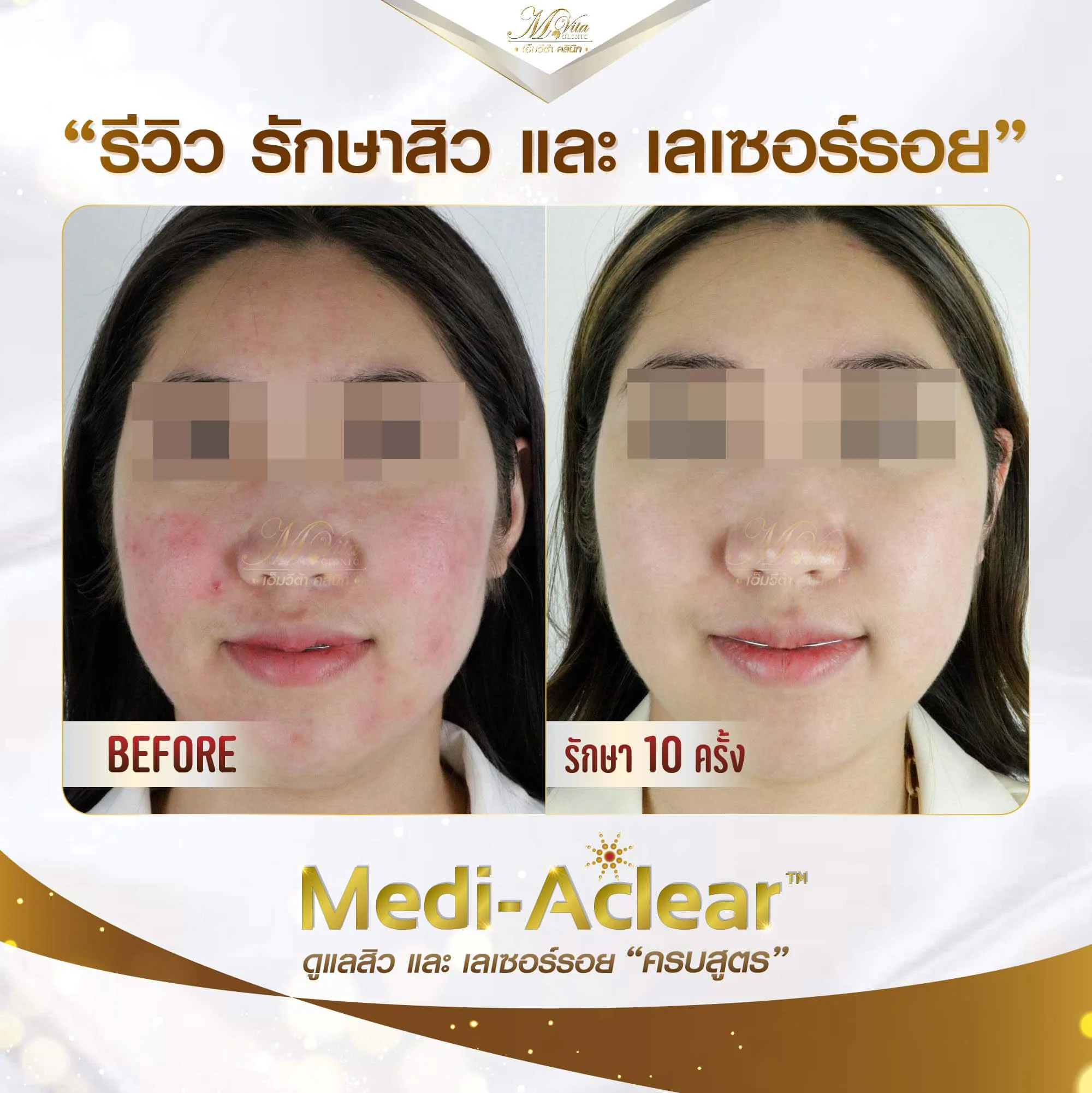 รีวิวรักษารอยแดงด้วยเลเซอร์