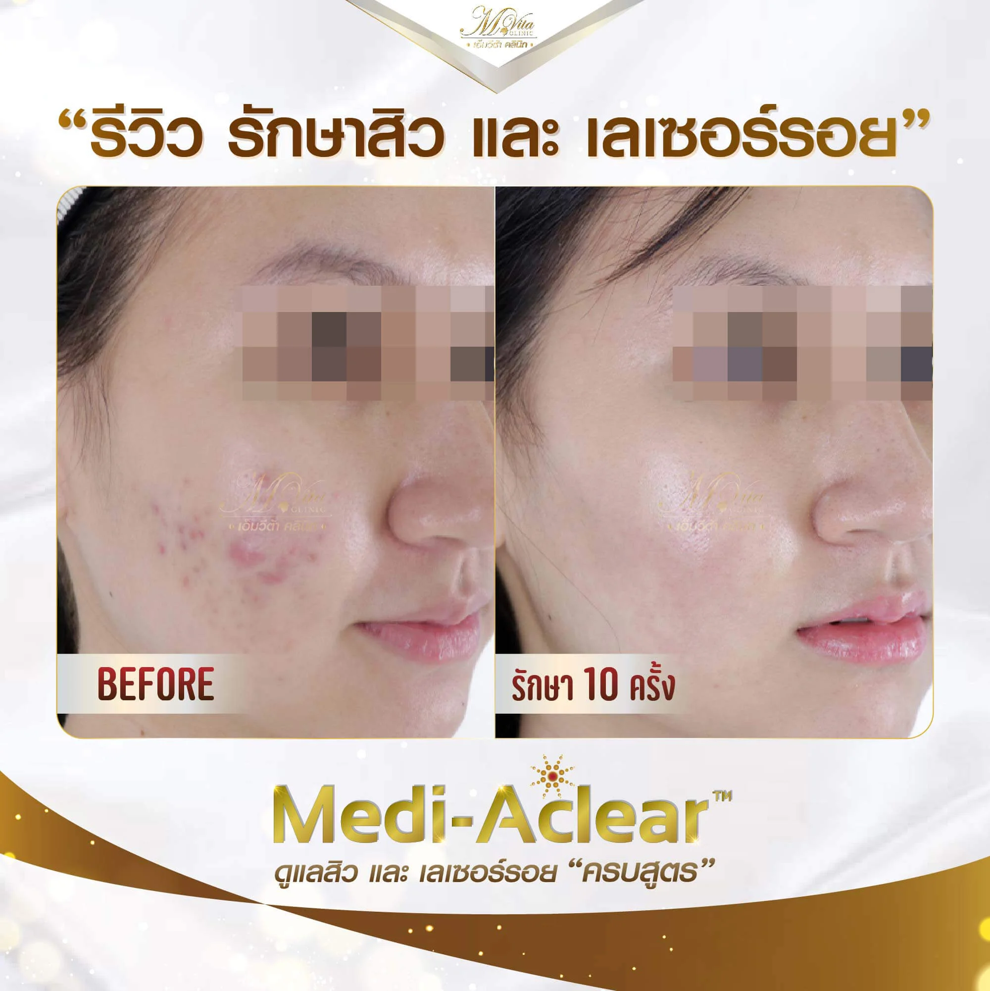 รีวิวเลเซอร์รอยแดงที่เกิดจากสิว