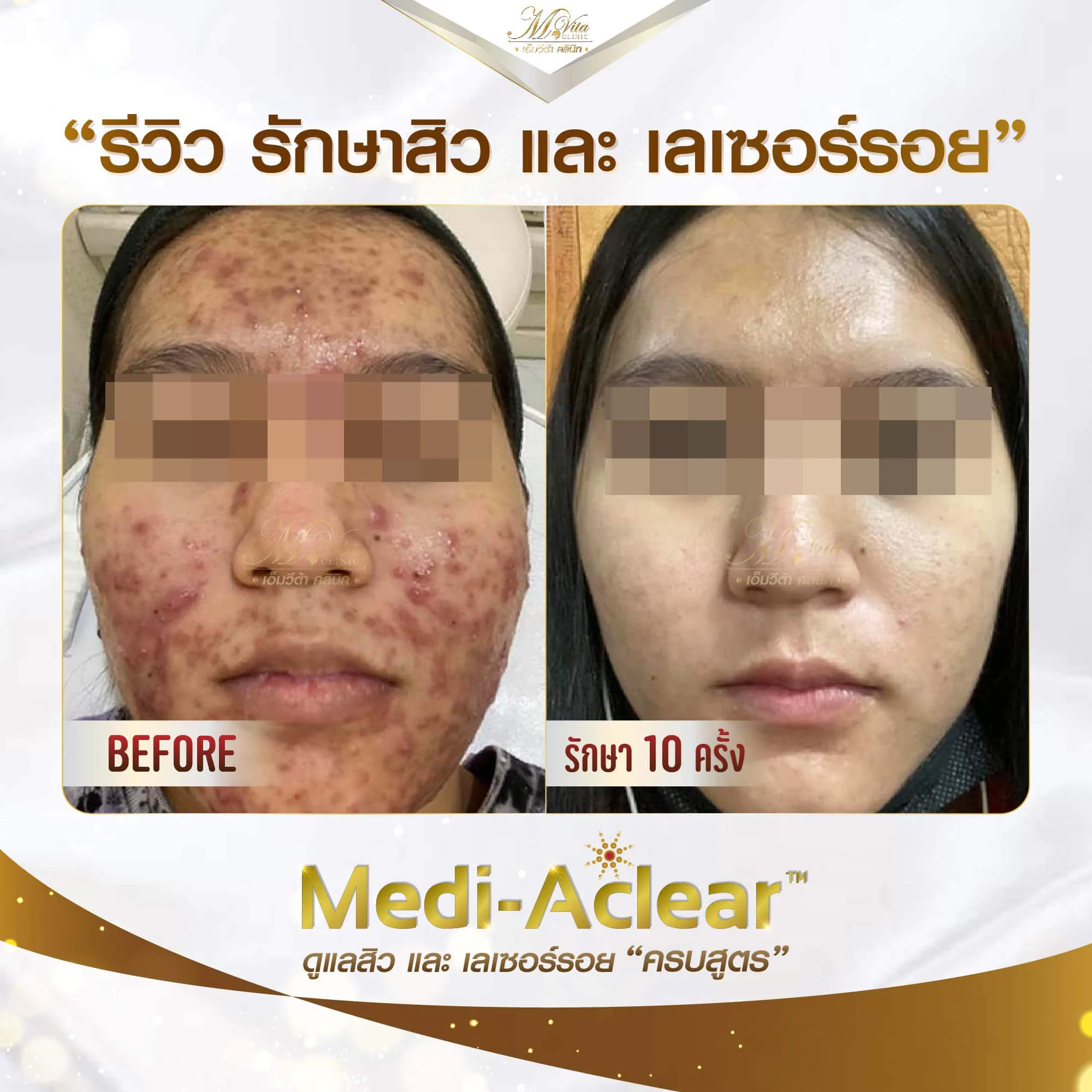 รีวืวรักษาสิวและรอยสิว หลังจากทำ 10 ครั้ง