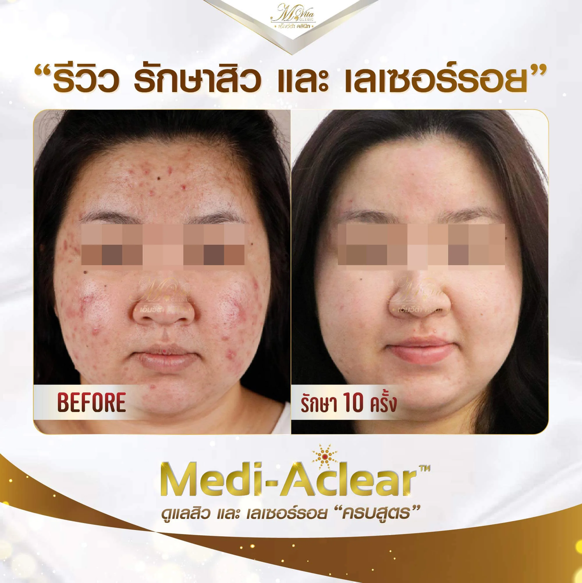 รีวิวรักษาสิวเลเซอร์