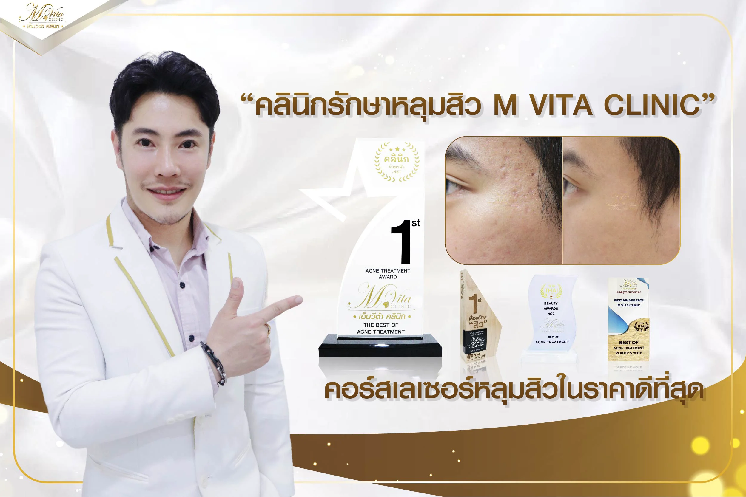 M VITA CLINIC คลินิกรักษาหลุมสิวได้มาตรฐาน เห็นผลได้จริง