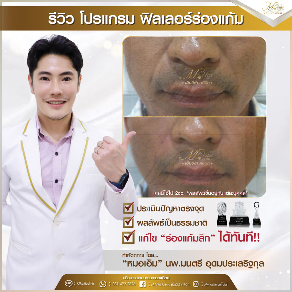รีวิว ฟิลเลอร์ร่องแก้ม