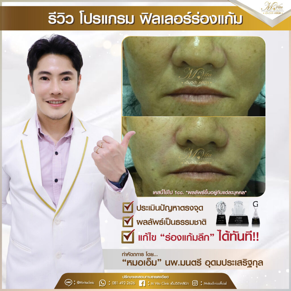 รีวิว ฟิลเลอร์ร่องแก้ม
