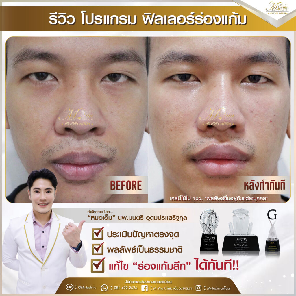 รีวิว ฟิลเลอร์ร่องแก้ม