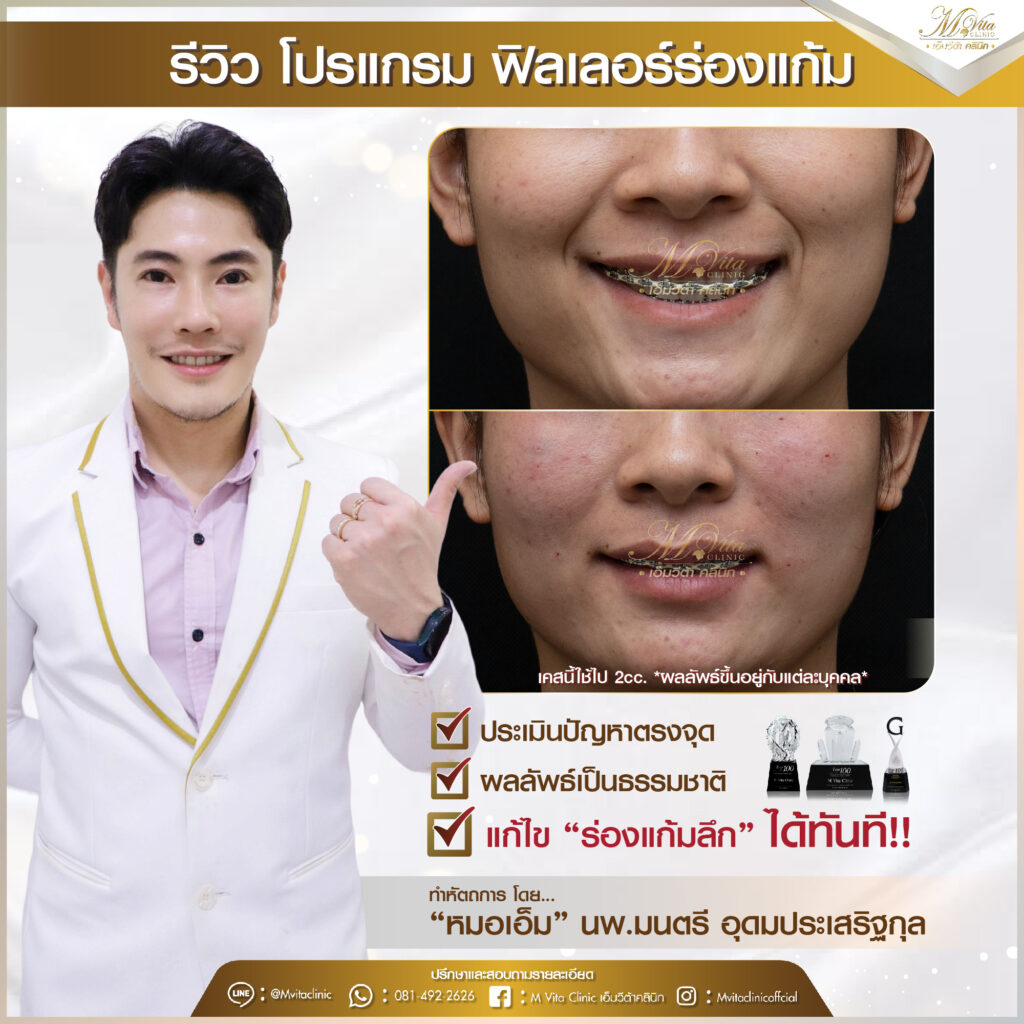 รีวิว ฟิลเลอร์ร่องแก้ม