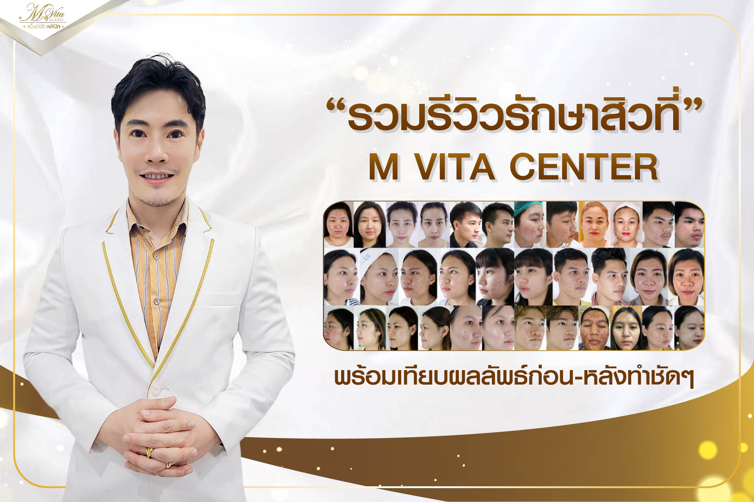 รวมรีวิวรักษาสิวที่ M VITA CENTER พร้อมเทียบผลลัพธ์ก่อน-หลังทำชัด ๆ