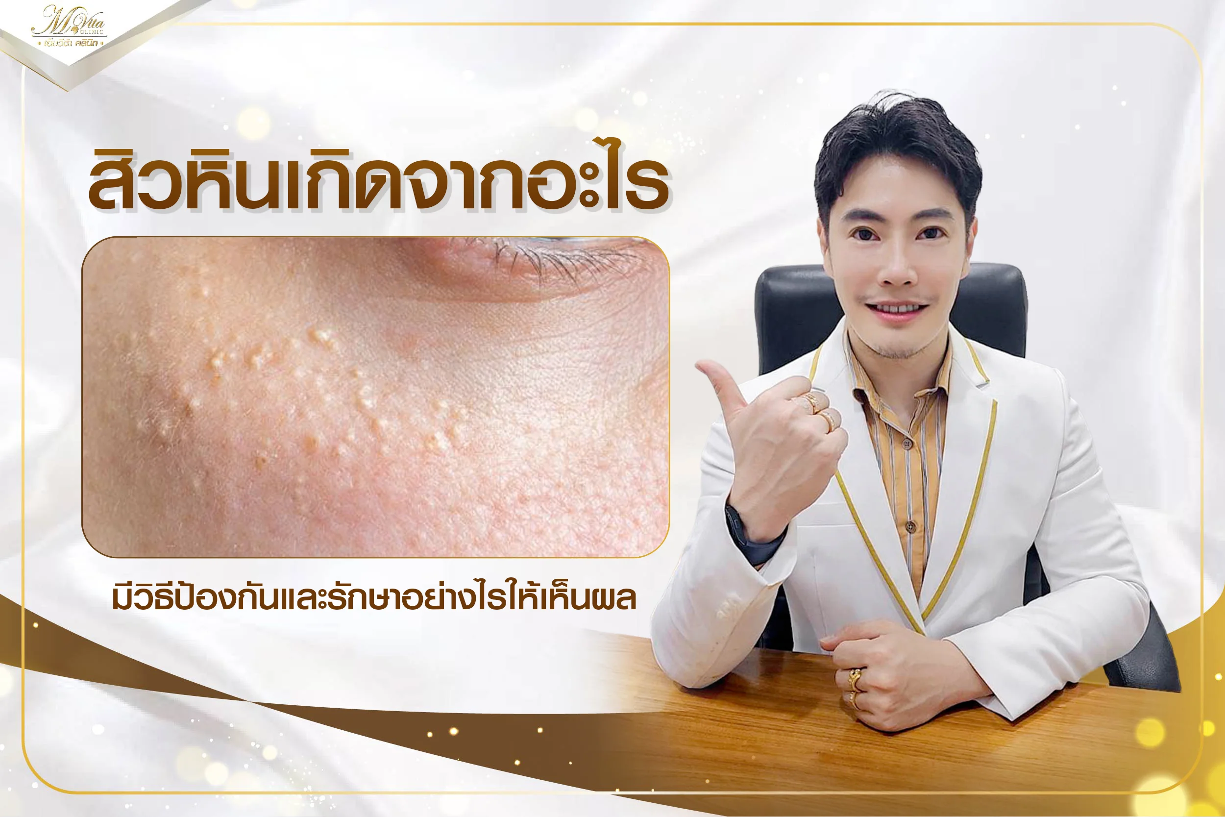 สิวหินเกิดจากอะไร ไขข้อสงสัยพร้อมเคล็ดลับวิธีรักษาให้เห็นผล