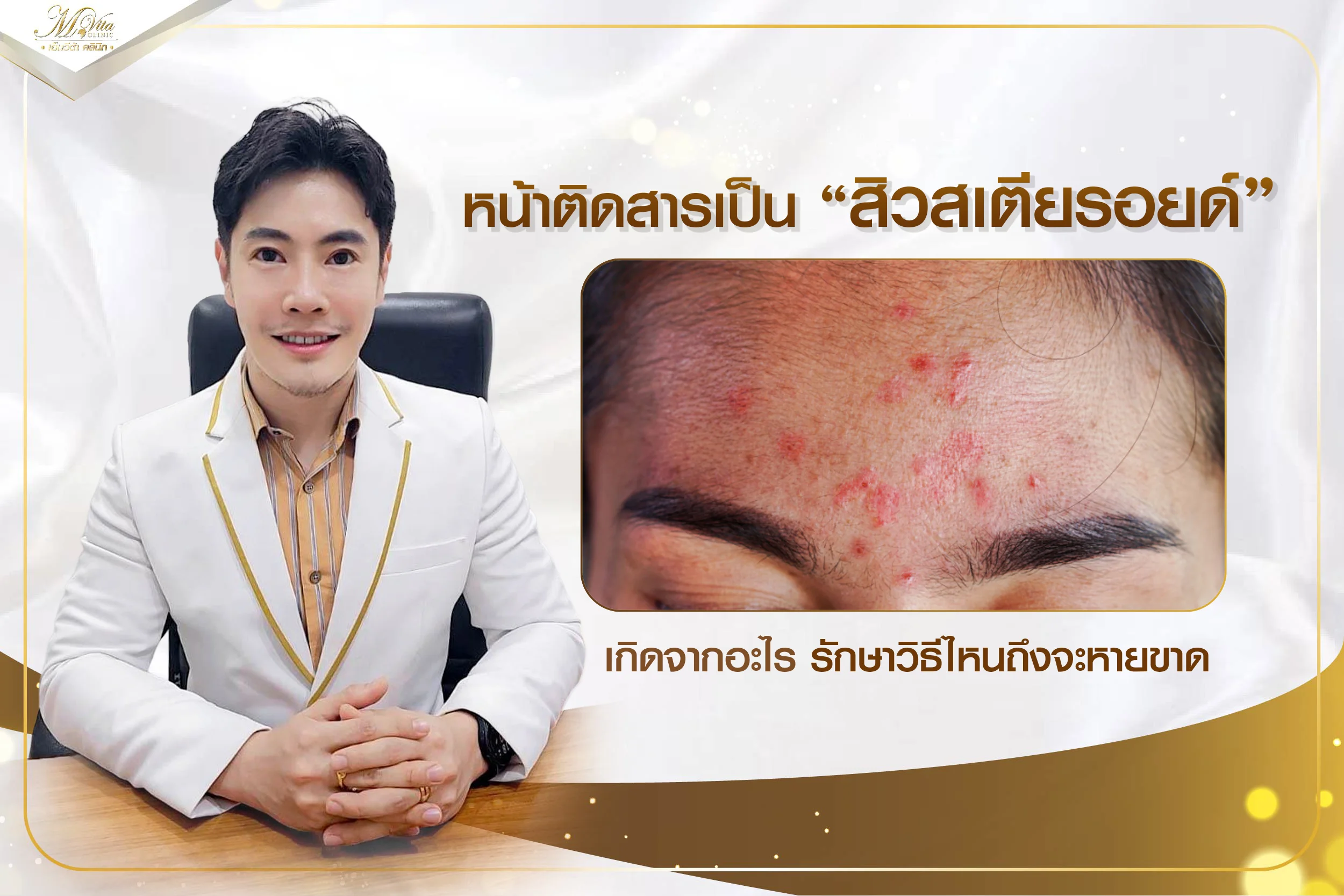 สิวสเตียรอยด์คืออะไร เกิดจากอะไร รักษายังไงถึงจะหายขาด