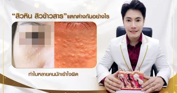 สิวหิน สิวข้าวสาร แตกต่างกันอย่างไร