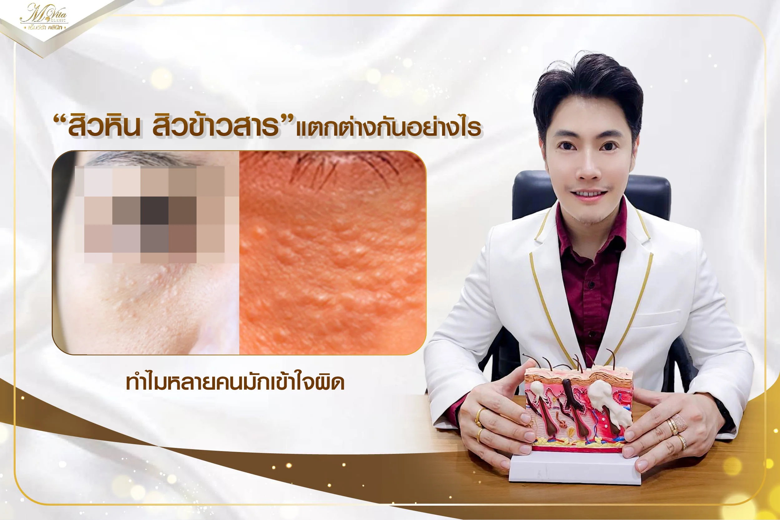 สิวหิน สิวข้าวสาร แตกต่างกันอย่างไร ทำไมหลายคนมักเข้าใจผิด