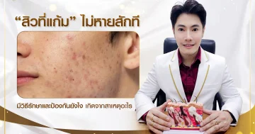 เป็นสิวเรื้อรังที่แก้มไม่หายสักที มีสาเหตุมาจากอะไร มีวิธีรักษายังไงบ้าง