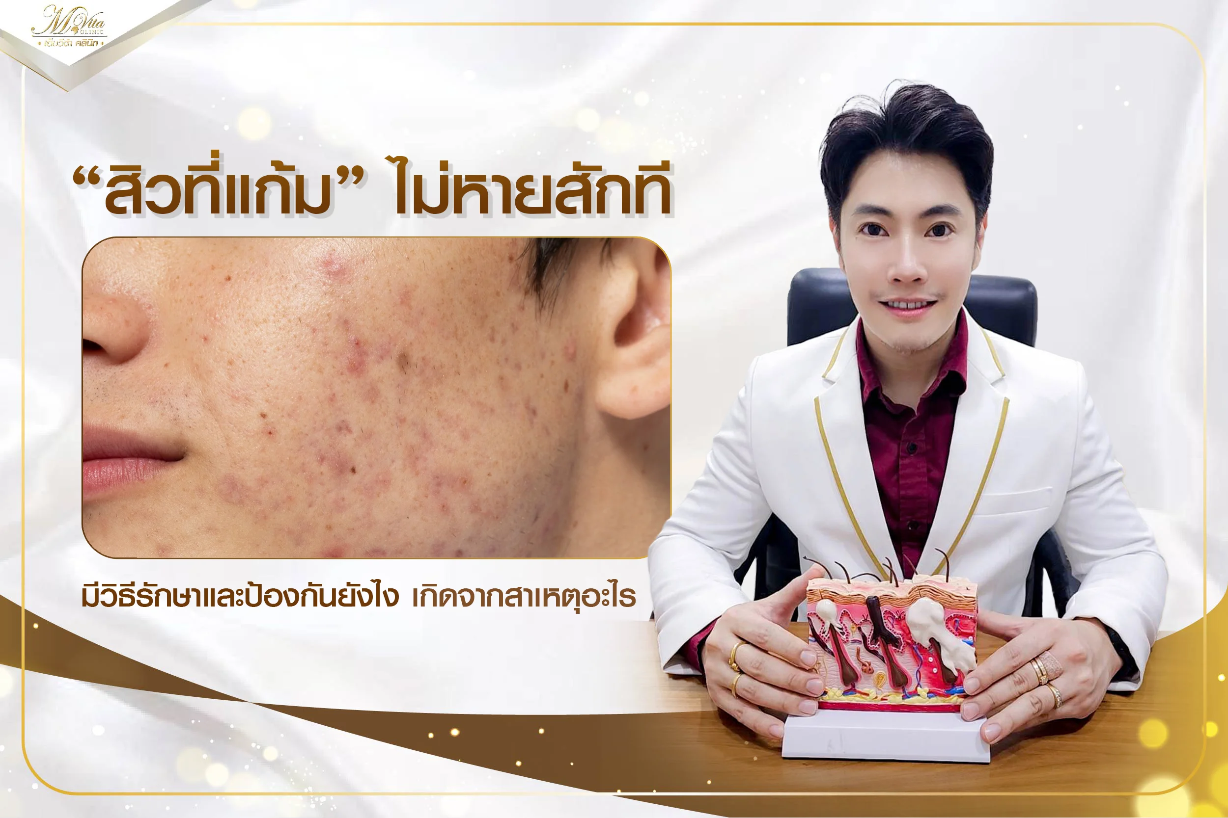 เป็นสิวที่แก้มไม่หายสักที มีสาเหตุมาจากอะไร มีวิธีรักษายังไงบ้าง