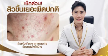 ทำไมสิวขึ้นเยอะผิดปกติ