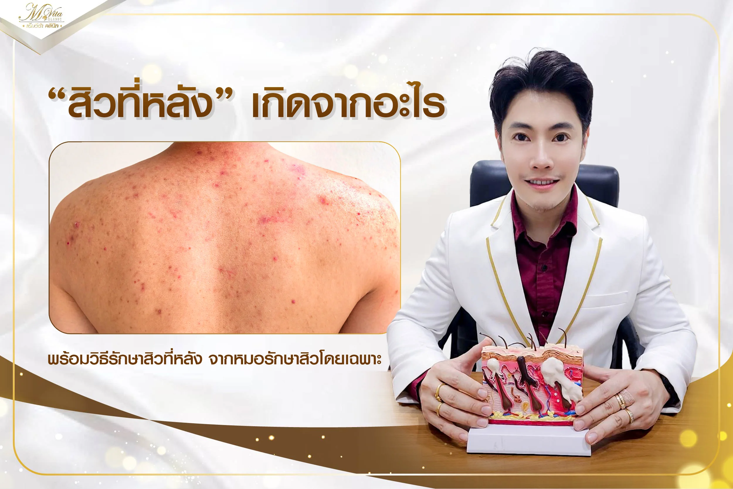 ไขข้อสงสัย สิวที่หลังเกิดจากอะไร มีวิธีรักษายังไงให้หลังกลับมาเนียนใส