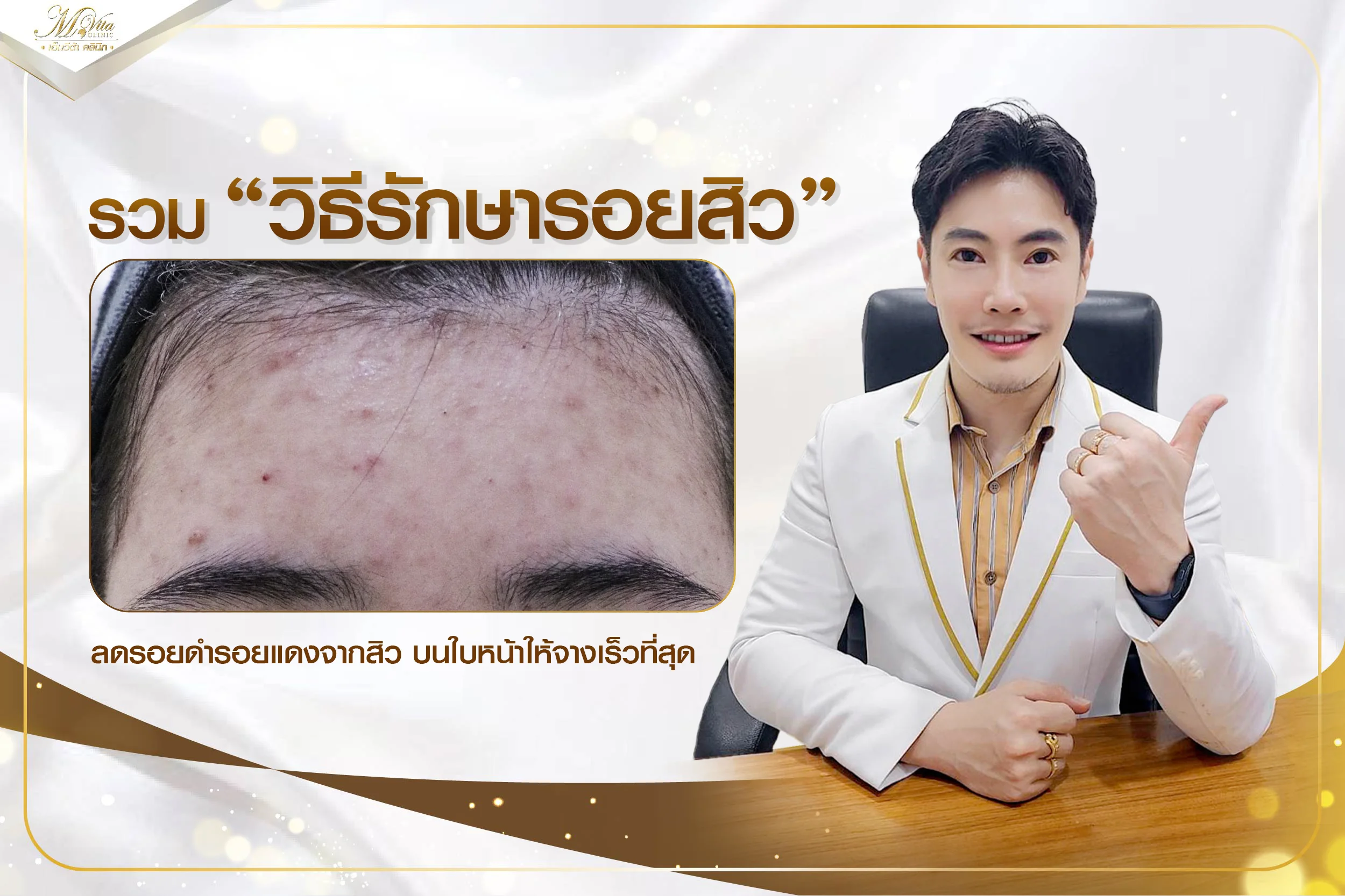รวมวิธีรักษารอยดำจากสิวเร็วที่สุด คืนใบหน้าเนียนใสใน 1 สัปดาห์