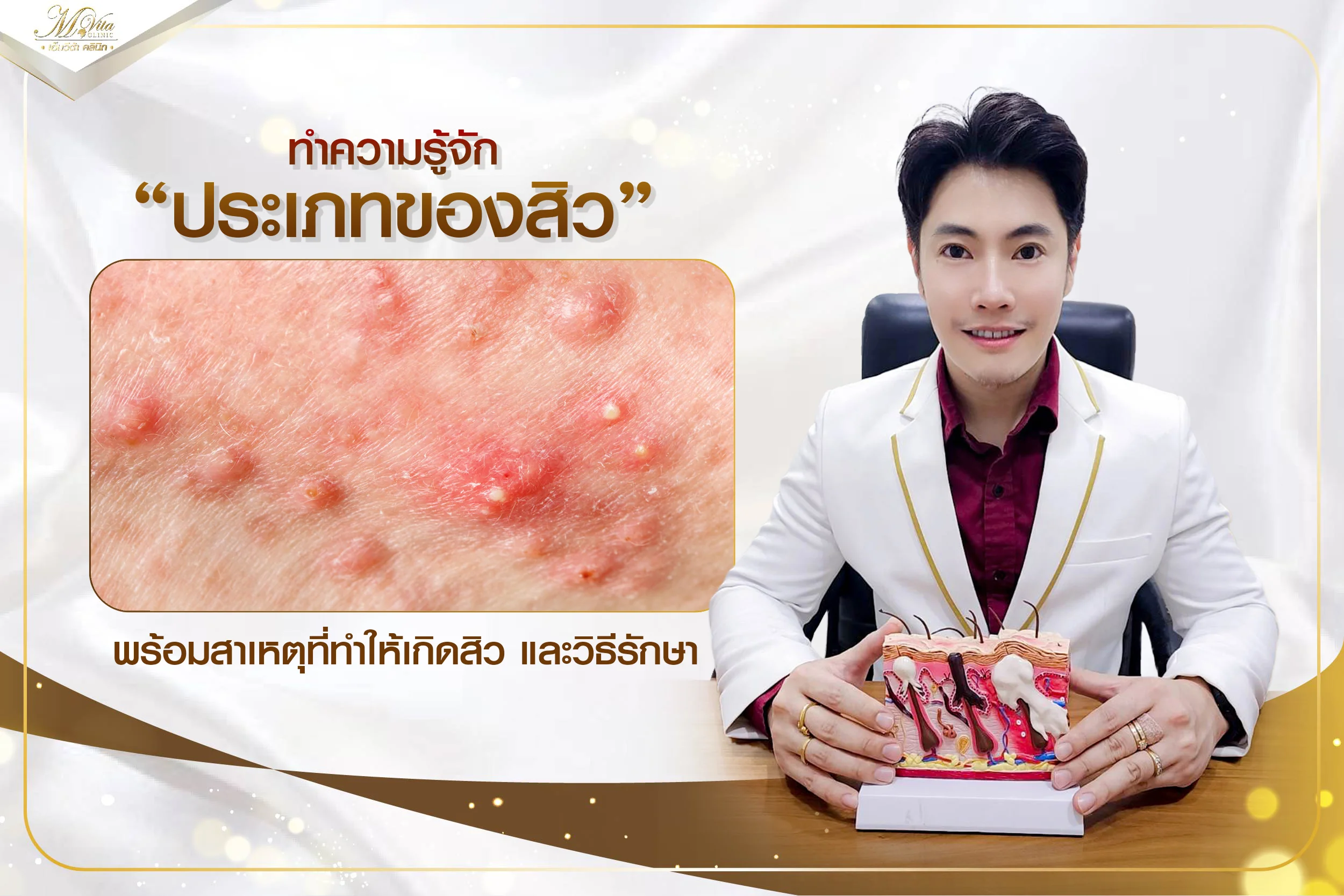 สิวมีกี่ประเภท รู้จักประเภทของสิว แต่ละประเภทต่างกันยังไง รักษายังไง
