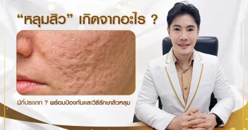 รวมเรื่องต้องรู้ หลุมสิวเกิดจากอะไร รักษาหลุมสิวยังไงให้ผิวหน้าเรียบเนียน