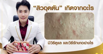 สิวอุดตัน (Comedones) เกิดจากอะไร พร้อมวิธีรักษาและดูแลที่เหมาะสม