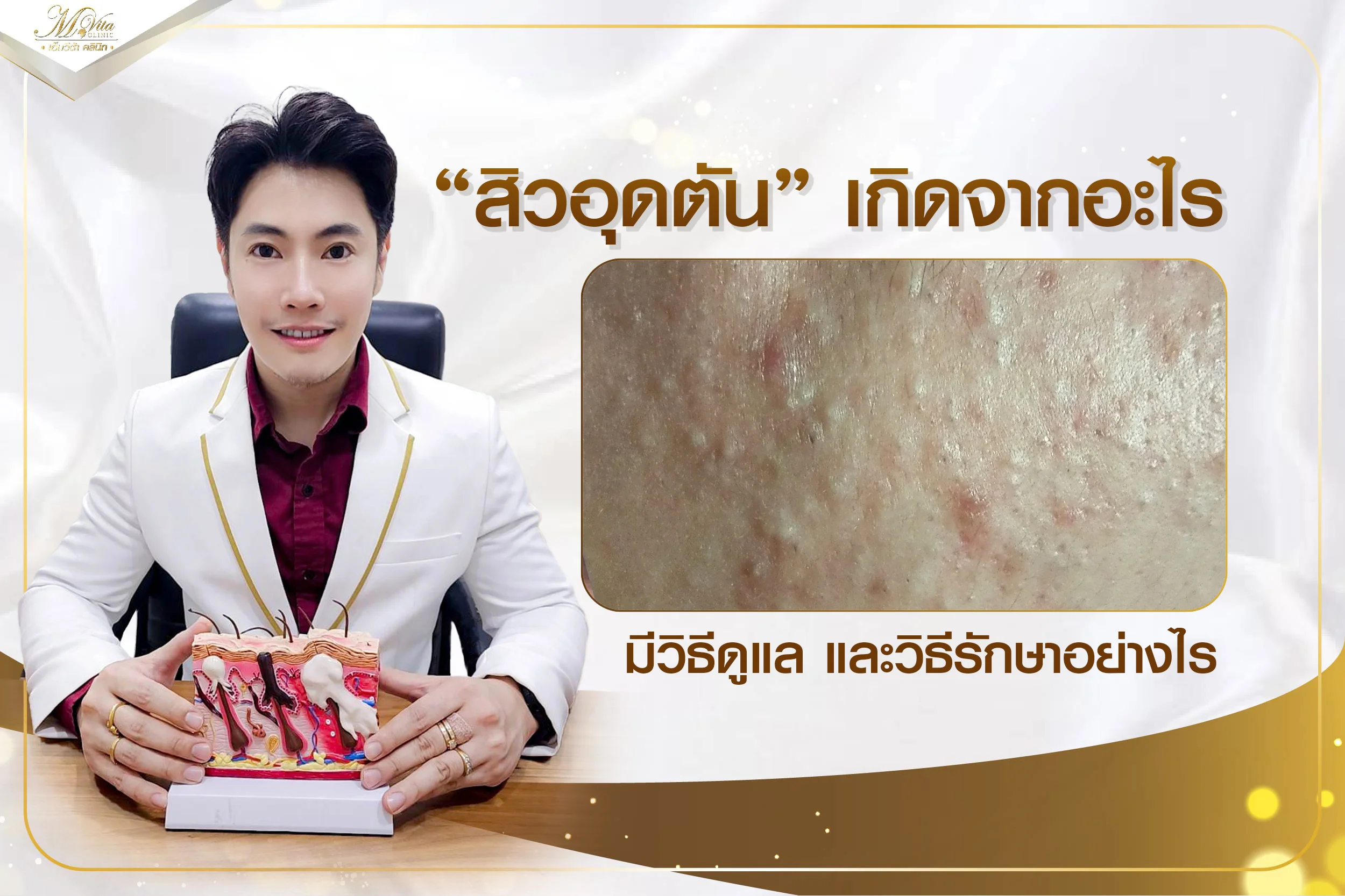 สิวอุดตัน (Comedones) เกิดจากอะไร พร้อมวิธีรักษาและดูแลที่เหมาะสม