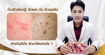 สิวผด กับ สิวอุดตัน