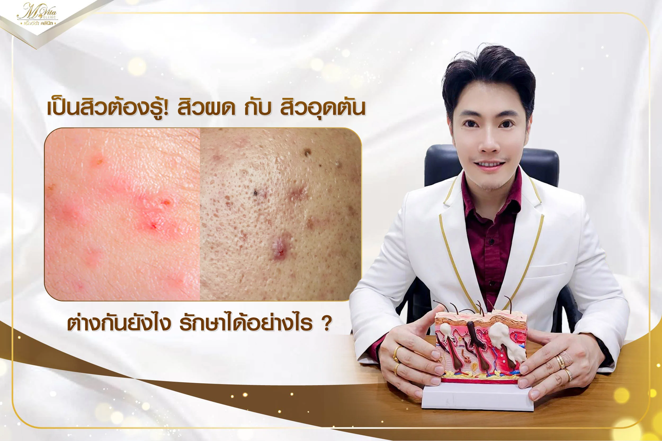 เป็นสิวต้องรู้! สิวผด กับ สิวอุดตัน ต่างกันยังไง รักษาได้อย่างไร