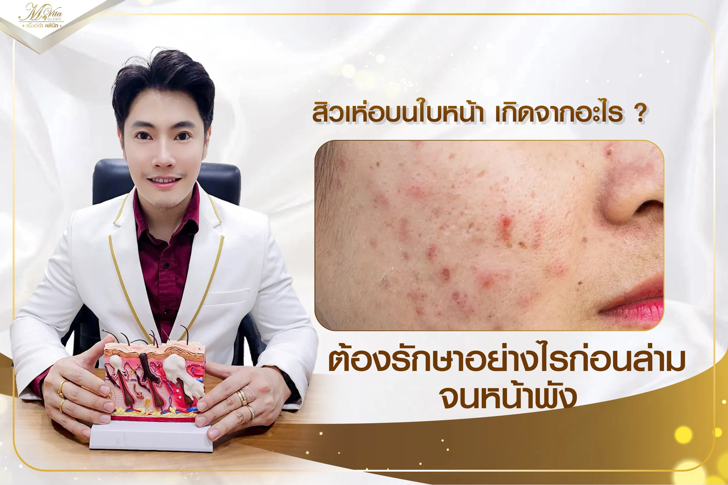 สิวเห่อบนใบหน้า เกิดจากอะไร ต้องรักษายังไงก่อนลามจนหน้าพัง