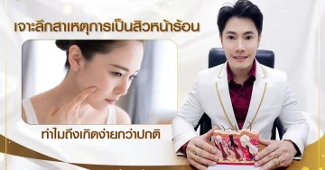 เจาะลึกสาเหตุการเป็นสิวหน้าร้อน ทำไมถึงเกิดง่ายกว่าปกติ