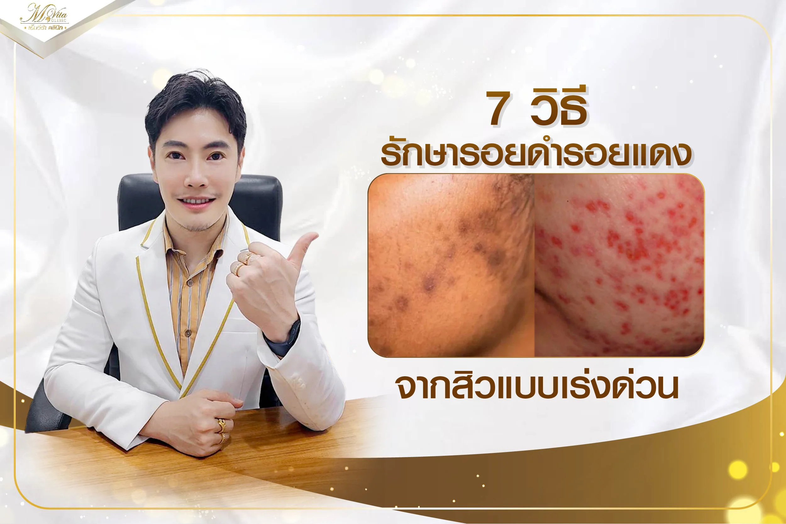 แชร์วิธีรักษารอยดํา รอยแดงจากสิวแบบเร่งด่วน