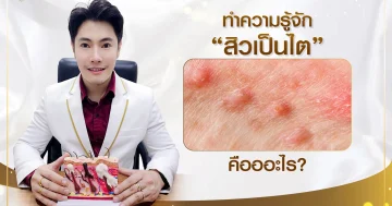 ทำความรู้จักสิวเป็นไตคืออะไร