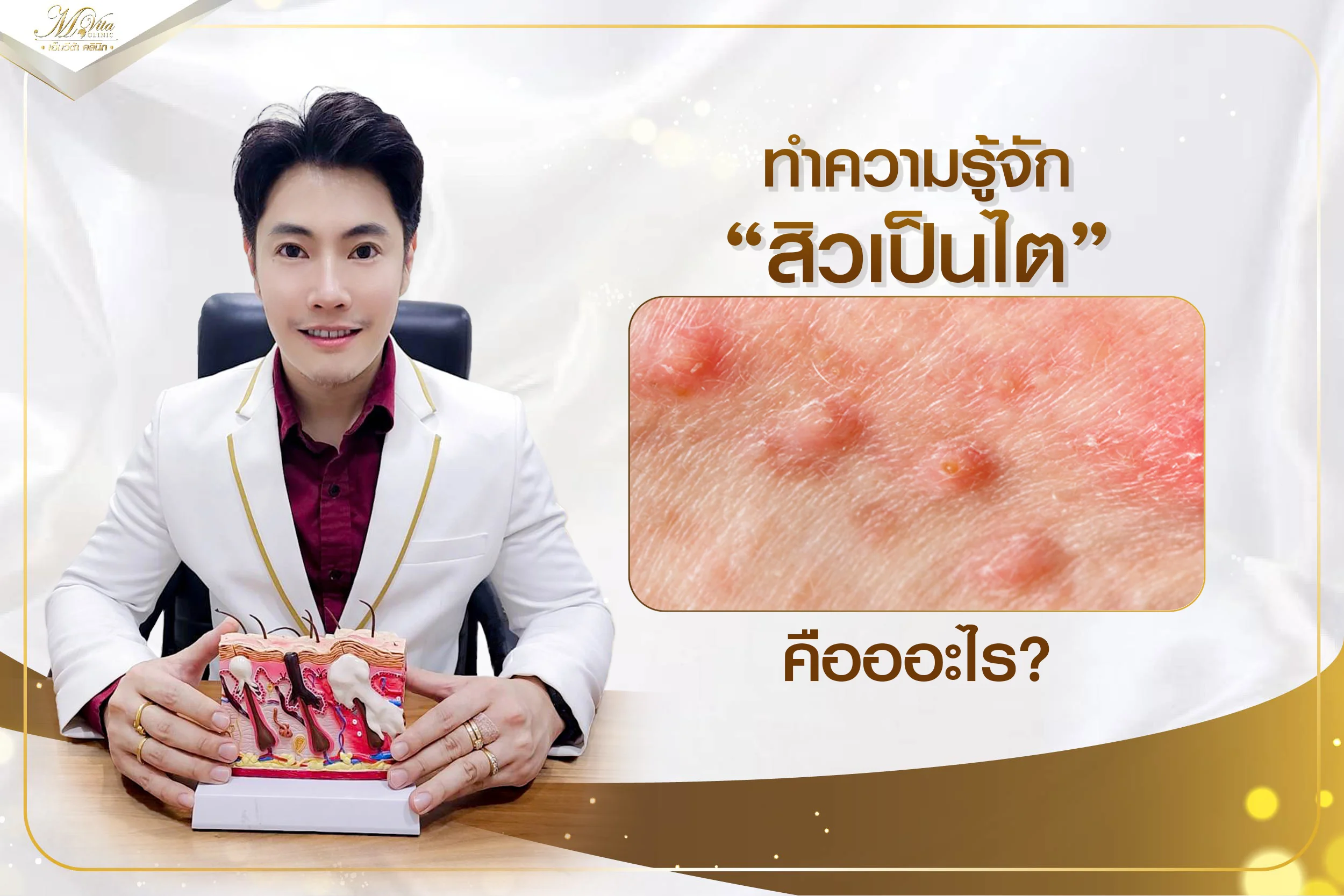 สิวเป็นไต (Nodular Acne) คืออะไร มีวิธีรักษาอย่างไรบ้าง
