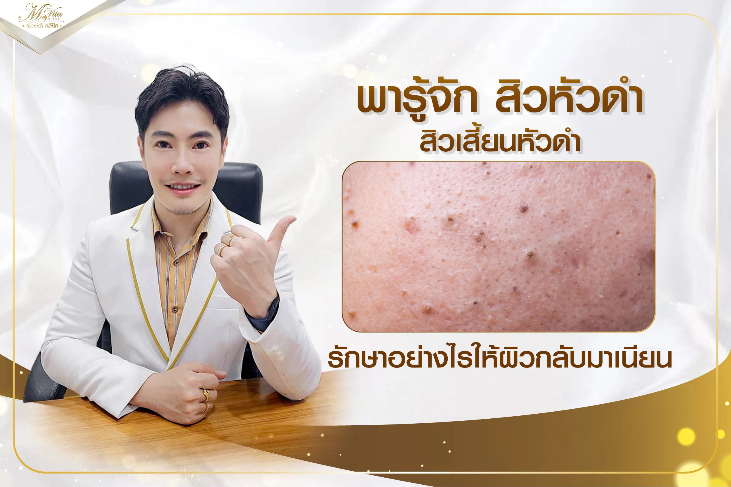 พารู้จัก สิวหัวดำ สิวเสี้ยนหัวดำ รักษาอย่างไรให้ผิวกลับมาเนียน