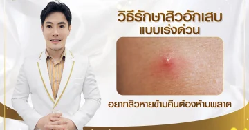  วิธีรักษาสิวอักเสบแบบเร่งด่วน อยากสิวหายข้ามคืนต้องห้ามพลาด