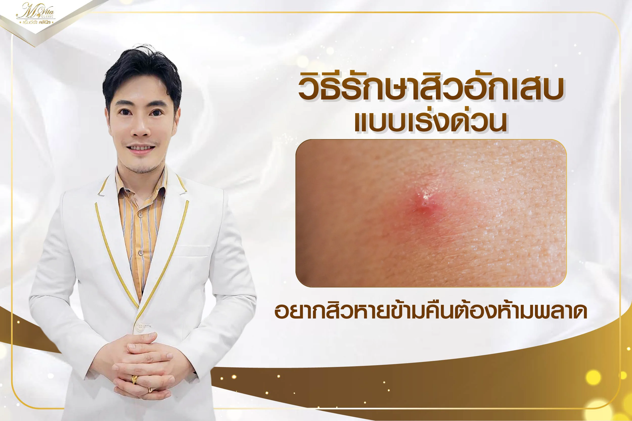 วิธีรักษาสิวอักเสบแบบเร่งด่วน อยากสิวหายข้ามคืนต้องห้ามพลาด