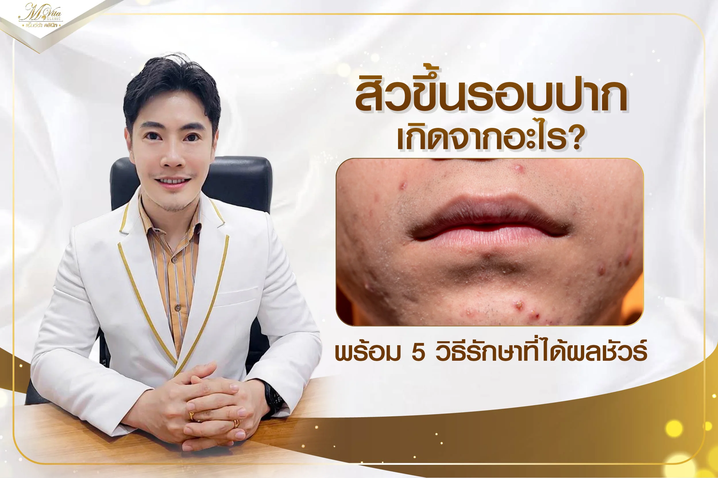 สิวขึ้นรอบปาก เกิดจากอะไร? พร้อม 5 วิธีรักษาที่ได้ผลชัวร์