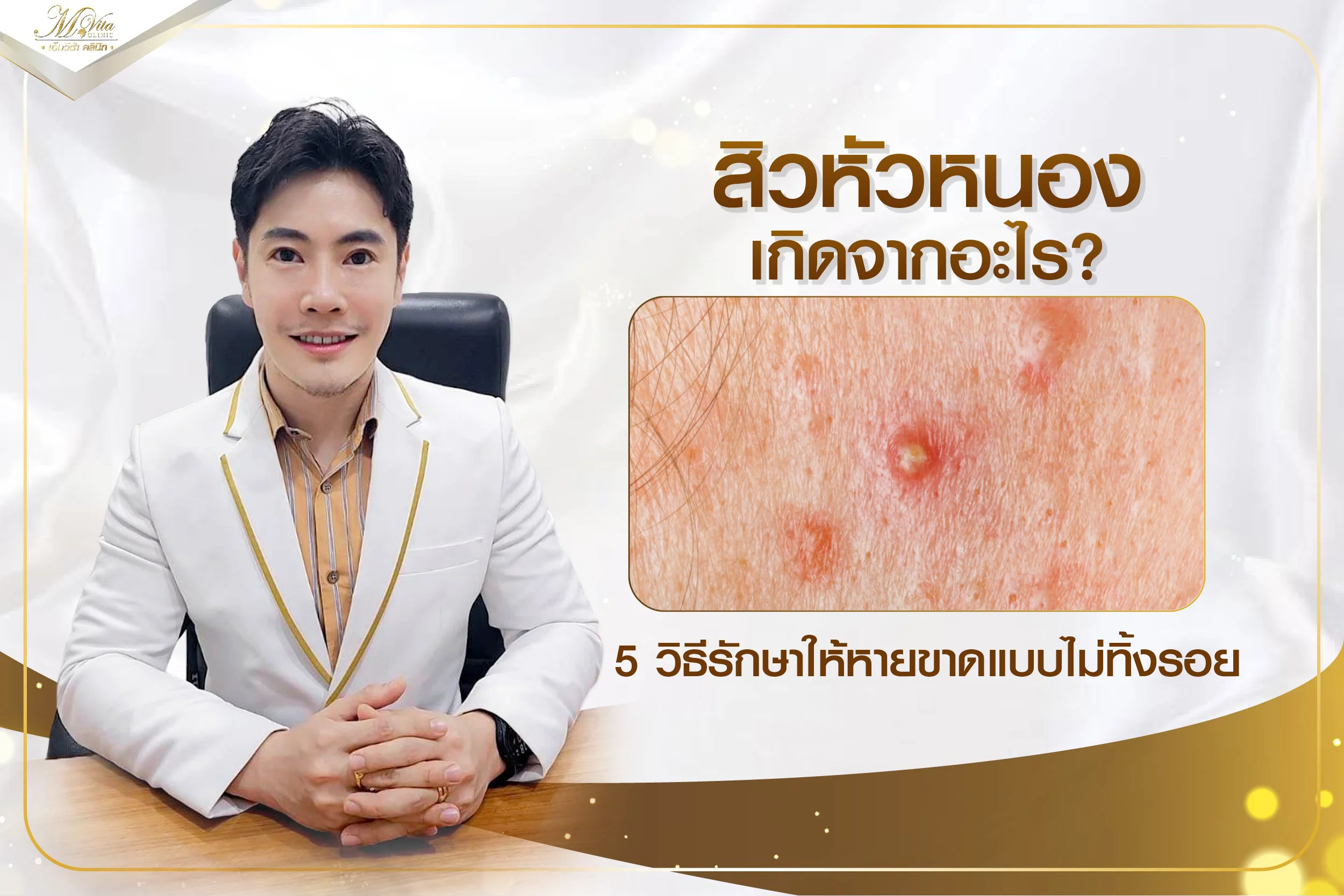 สิวหัวหนองเกิดจากอะไร? 5 วิธีรักษาให้หายขาดแบบไม่ทิ้งรอย