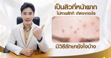 เป็นสิวที่หน้าผากไม่หายสักที เกิดจากอะไร มีวิธีรักษายังไงบ้าง