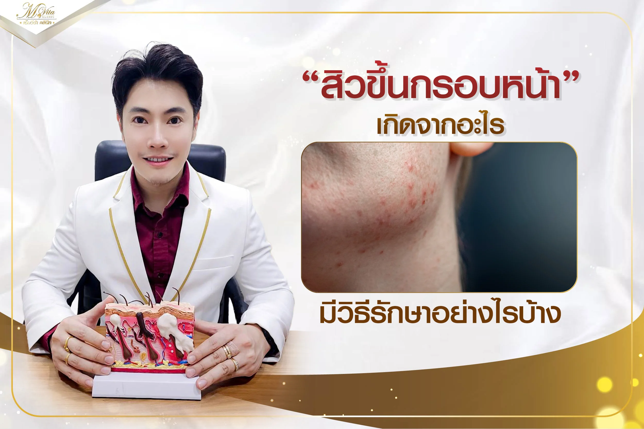 สิวขึ้นกรอบหน้าเกิดจากอะไร มีวิธีป้องกันและรักษาอย่างไรบ้าง
