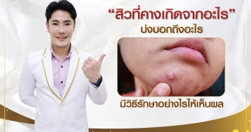 สิวที่คางเกิดจากอะไร บ่งบอกถึงอะไร มีวิธีรักษาอย่างไรให้เห็นผล