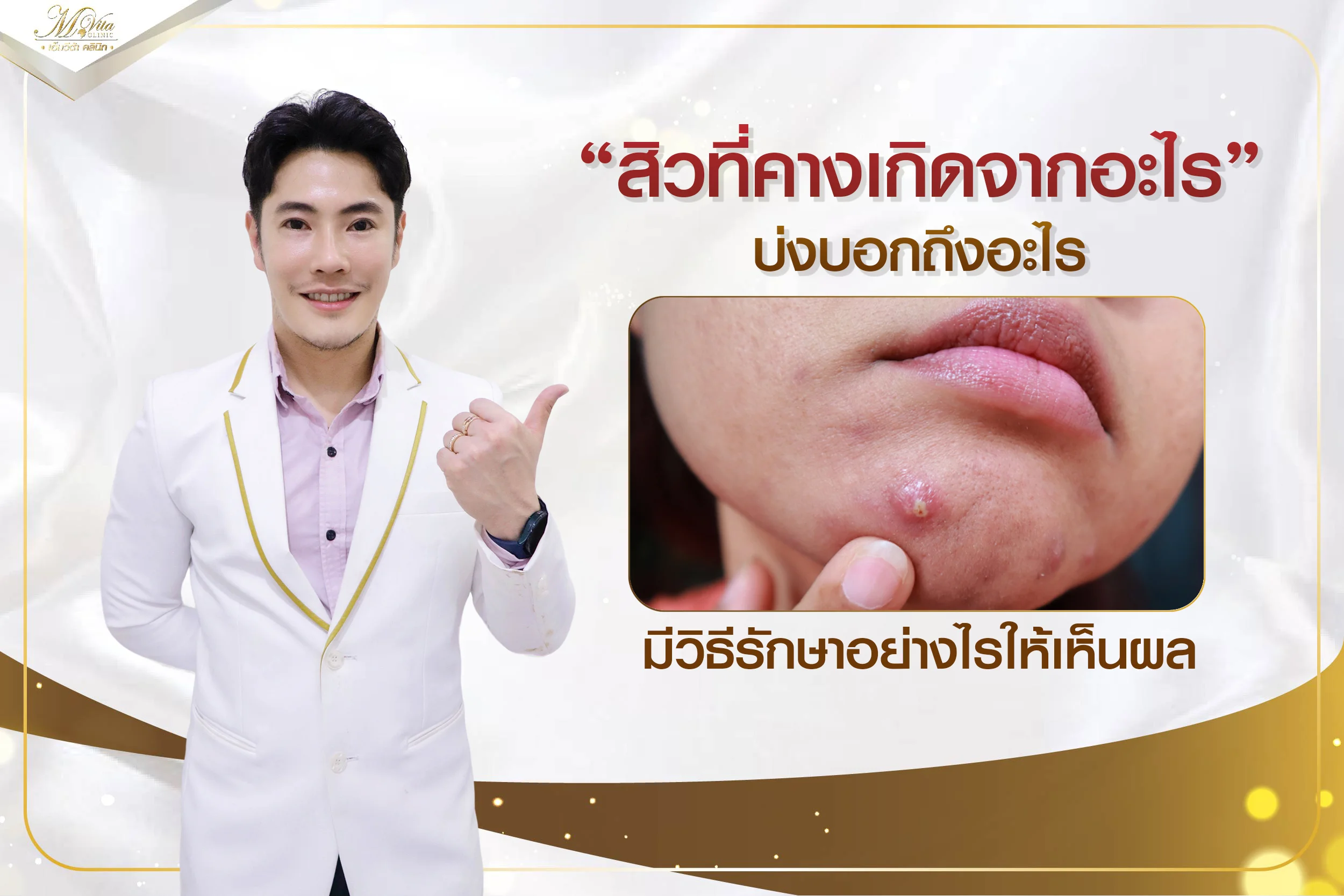 สิวที่คางเกิดจากอะไร ขึ้นเพราะฮอร์โมนจริงไหม มีวิธีรักษาอย่างไรบ้าง