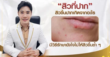 สิวที่ปาก สิวขึ้นปากเกิดจากอะไร มีวิธีรักษายังไงไม่ให้สิวขึ้นซ้ำ ๆ