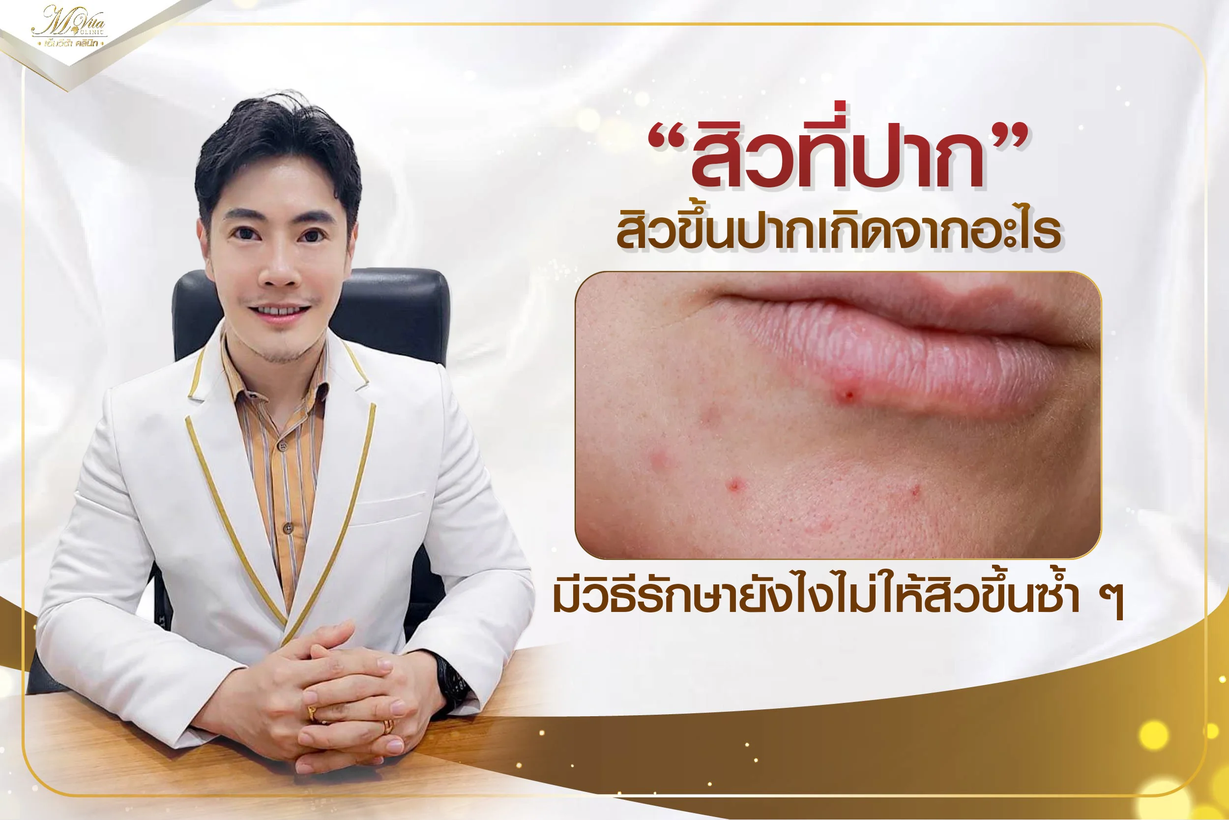 สิวที่ปากเกิดจากอะไร มีวิธีป้องกันและรักษาสิวที่ปากไม่ให้ขึ้นซ้ำยังไงบ้าง