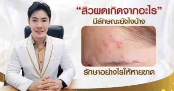 สิวผดเกิดจากอะไร มีลักษณะยังไงบ้าง รักษาอย่างไรให้หายขาด