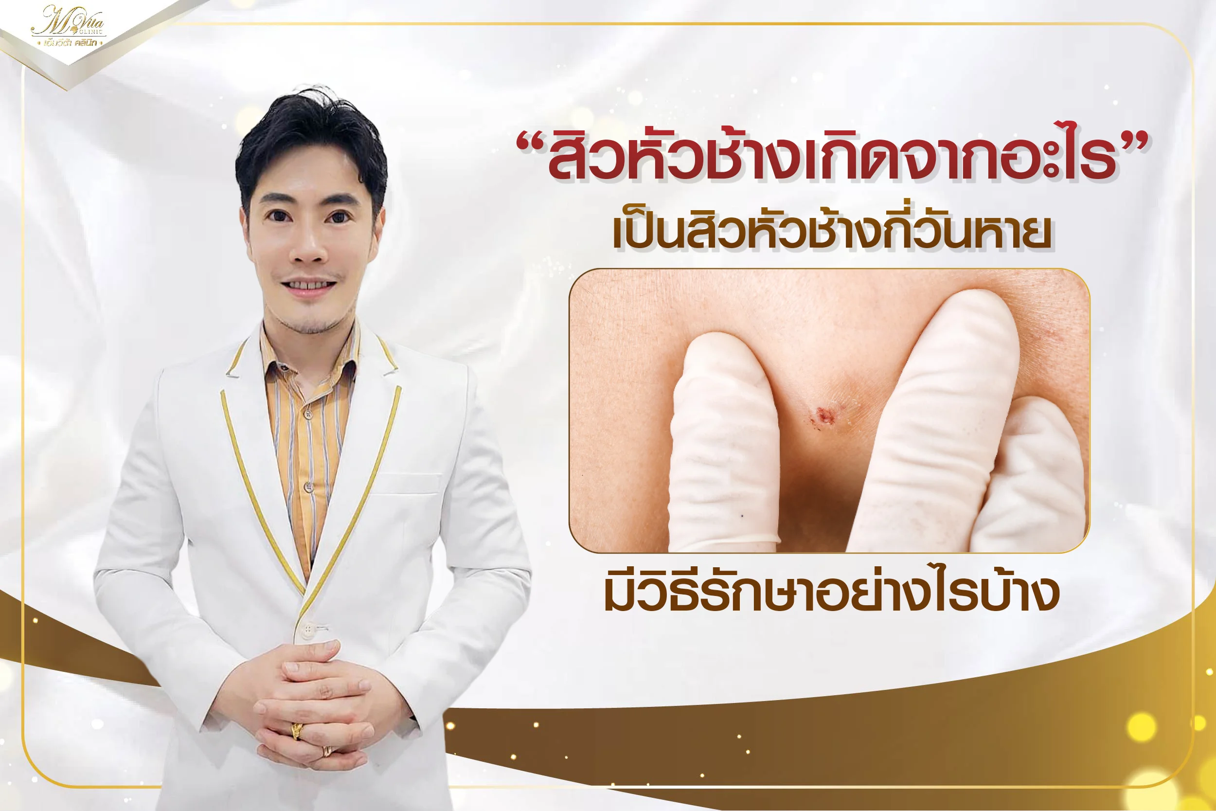ไขข้อสงสัย เป็นสิวหัวช้างกี่วันหาย เกิดจากอะไร มีวิธีรักษายังไงบ้าง