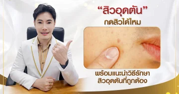 สิวอุดตันกดสิวได้ไหม พร้อมแนะนำวิธีรักษาสิวอุดตันที่ถูกต้อง