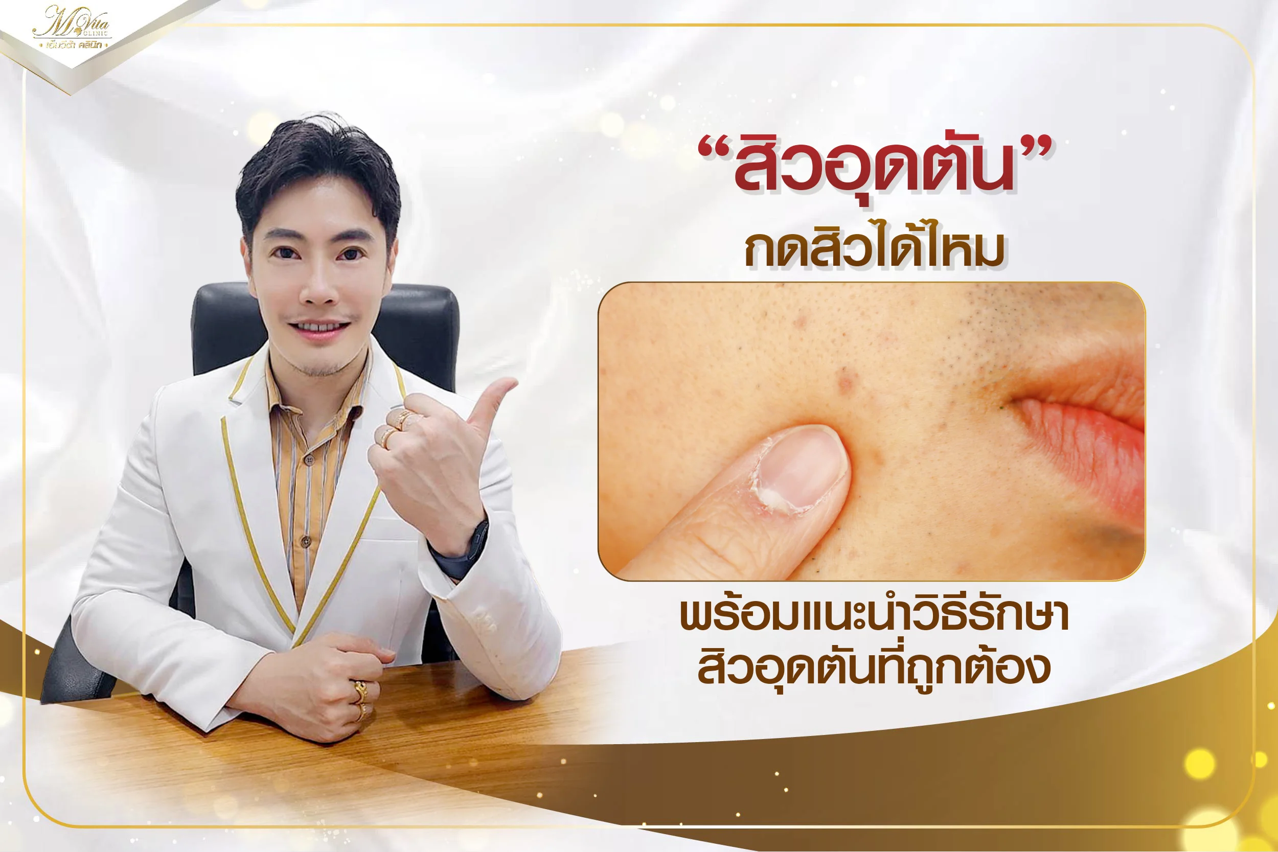 สิวอุดตันกดสิวได้ไหม กดสิวอย่างไรถึงจะไม่ทิ้งรอยสิวเอาไว้