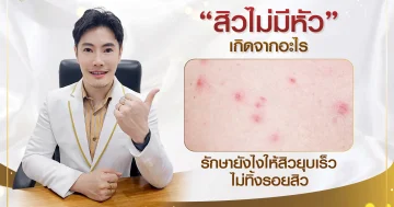 สิวไม่มีหัวเกิดจากอะไร มีรักษายังไงให้สิวยุบเร็ว ไม่ทิ้งรอยสิว