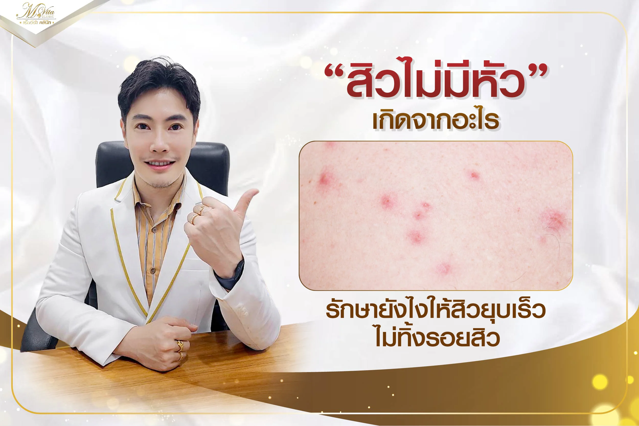 ไขข้อสงสัย สิวไม่มีหัวเกิดจากอะไร รักษายังไงให้เห็นผลไว